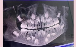 牙齿正畸前，到底要不要做血检？有必要吗？