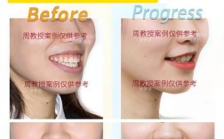 牙齿咬合不正自我矫正，真的靠谱吗？