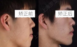 上海华驰牙齿正畸效果怎么样？医生专业度与价格靠谱吗？