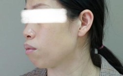 38岁矫正牙齿的后果