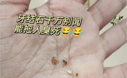 拜博口腔牙结石