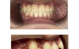 上海在线咨询牙齿正畸，流程、费用和注意事项有哪些？