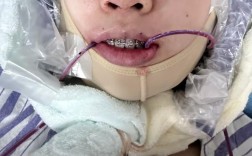 下颌偏斜正畸非手术