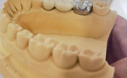 种牙后牙冠有点松动是什么原因？需要立即处理吗？