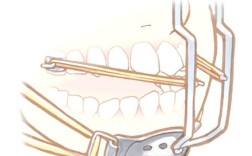 正畸一类牵引示意图