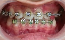 矫正后长期不种牙，口腔健康会有哪些隐患？