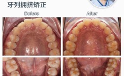 正畸模型拥挤度测量方法有哪些？不同测量方法的准确性如何影响正畸治疗方案的制定？