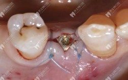 种牙 一期手术后