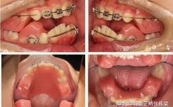 垫了下巴还能矫正牙齿