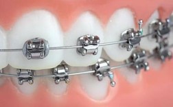 矫正牙齿的矫正器掉了