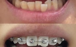 正畸会导致牙齿脱落吗？原因及预防方法有哪些？