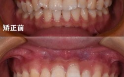 矫正完的牙齿，为何会悄悄反弹回原状？