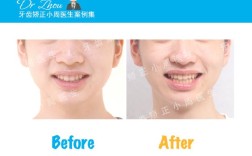 正畸打开咬合方面，这本书会详细解析哪些技术原理与临床操作要点？