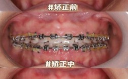 种植牙齿可以矫正