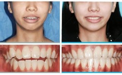 骨增量手术后为何不能正畸？