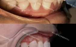 门牙前凸矫正，如何选择适合自己的矫正方法以达到最佳效果？