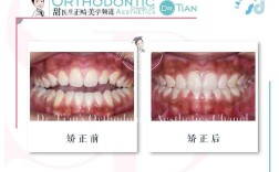 正畸没拔牙嘴会凸吗