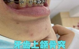 矫正牙齿会导致牙槽骨突出吗？