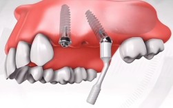种牙植骨的全过程包含哪些关键步骤？术前评估、植骨手术到最终戴牙，每个阶段有哪些注意事项和风险？