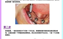 种牙手术步骤