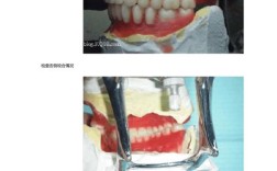 义齿变形的处理方法