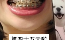 正畸期间门牙出现牙缝，是正常现象吗？