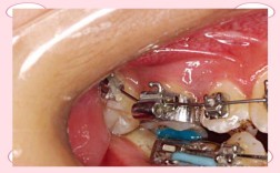 正畸带环是用于上牙还是下牙？