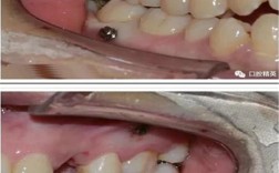 正畸微种植钉植入图片中，操作步骤、解剖结构识别与关键技术要点如何通过影像呈现？