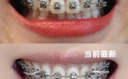 矫正牙齿的钢丝会断么