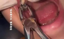 蛀牙拔了一定要种牙吗