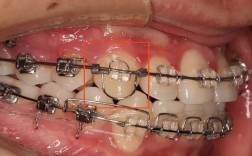 正畸辅弓拉弓外牙