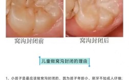 窝沟固化的方法不包括哪些具体操作？