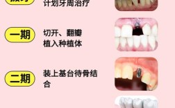 牙齿拥挤能种牙吗？具体该怎么操作？