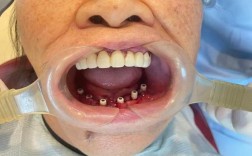 老年人镶牙种牙怎么选？晚年生活哪种更实用？