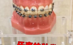 牙齿矫正牙套有几种？常见类型及优缺点有哪些？