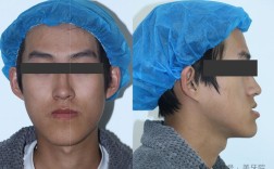 颌干扰治疗方法