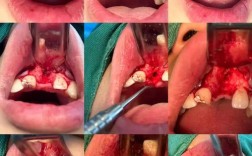 松牙翻瓣植骨后为何会痛？