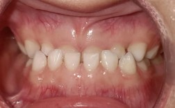 牙齿矫正只做上排，效果真的能好吗？