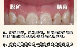 正畸白斑如何治疗