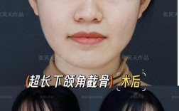 下颌平面角正畸