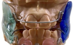 正畸Frank是什么？矫正牙齿的Frank技术是什么？