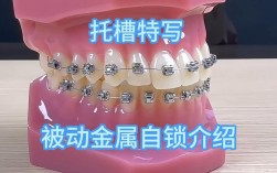 矫正牙齿选自锁托槽？视频揭秘优缺点与适用人群！