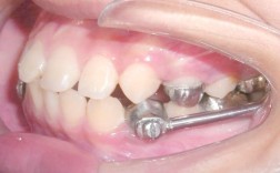 正畸最先进技术