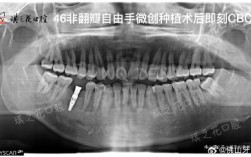 种牙前必须拍CT吗？这些检查到底有啥用？