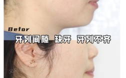 牙齿矫正真的会导致口齿不清吗？