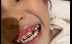 正畸拔牙一个月效果图效果如何？变化大不大？