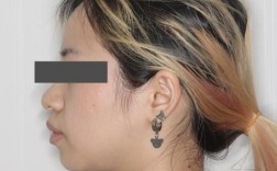 骨性前突做牙齿正畸，矫正效果能好吗？