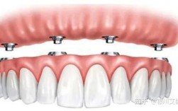 缺四颗牙为何种两棵种植体挂两颗牙冠？