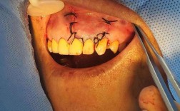 种牙后缝线处如何护理？会有肿胀疼痛吗？