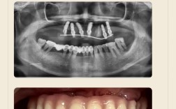 半口牙即种即用靠谱吗？当天种当天用效果如何？